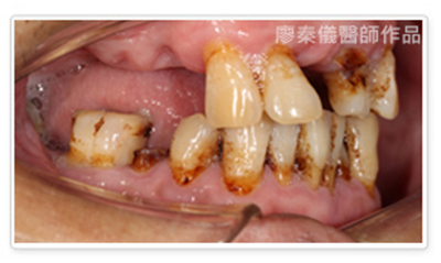 雷射牙周治療、使用雷射組織殺菌手術比起傳統更減少傷口感染風險，雷射牙周治療費用