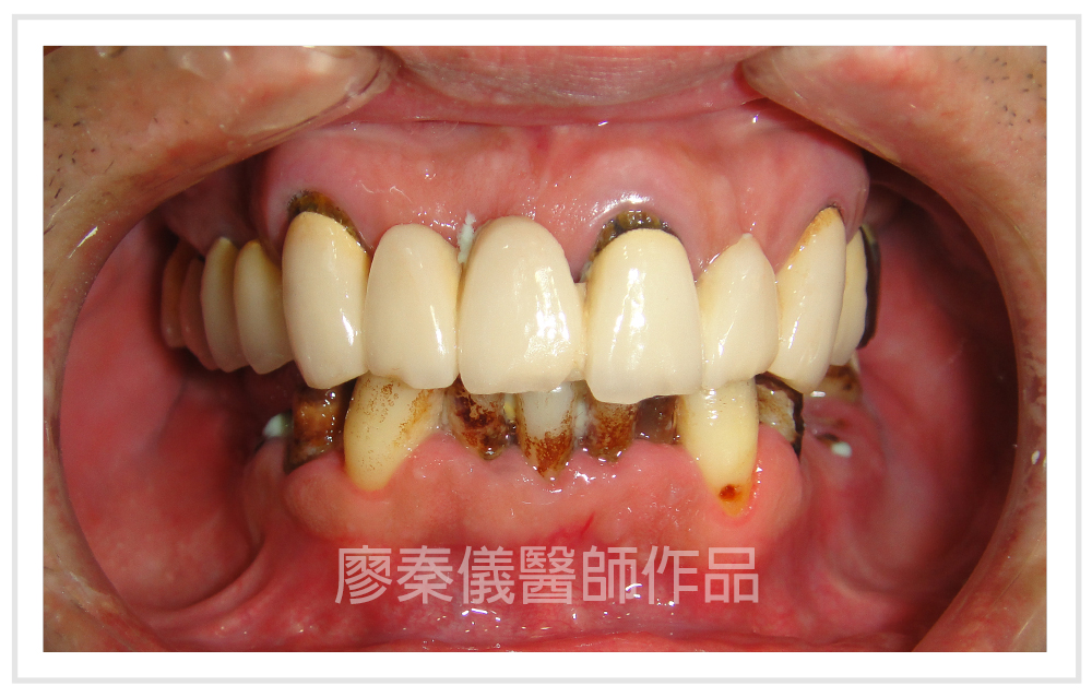 TCI舒眠牙醫治療,TCI舒眠植牙,舒眠植牙,三合一植牙,人工植牙