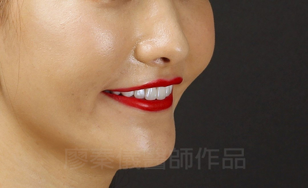 上顎牙齦美容,晶鑽全瓷冠,全瓷貼片
