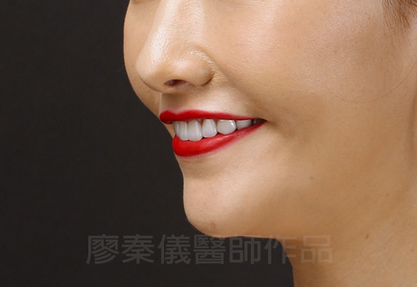 上顎牙齦美容,晶鑽全瓷冠,全瓷貼片