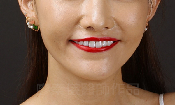 上顎牙齦美容,晶鑽全瓷冠,全瓷貼片
