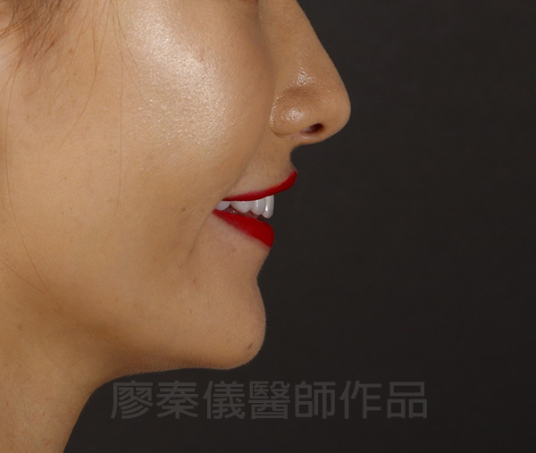 上顎牙齦美容,晶鑽全瓷冠,全瓷貼片