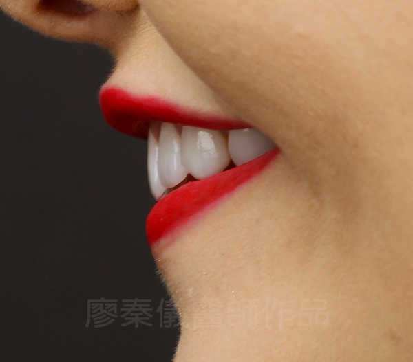 上顎牙齦美容,晶鑽全瓷冠,全瓷貼片