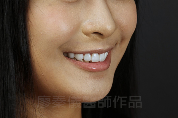 牙齦美容,全瓷冠貼片,去除黑色素