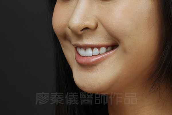 牙齦美容,全瓷冠貼片,去除黑色素