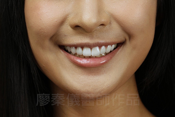 牙齦美容,全瓷冠貼片,去除黑色素