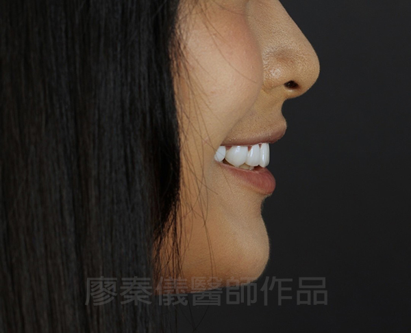 牙齦美容,全瓷冠貼片,去除黑色素