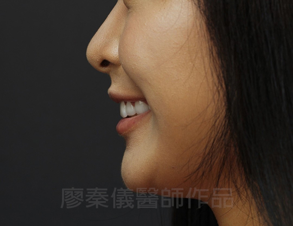 牙齦美容,全瓷冠貼片,去除黑色素