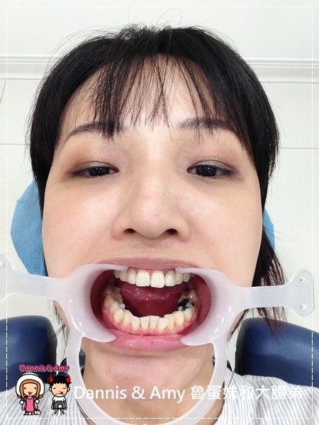 3D齒雕,美容牙科,晶鑽全瓷,即拔即種植牙