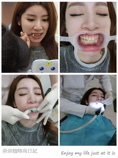 美容牙科,晶鑽全瓷,居家美白,牙齒美容,牙齒美白