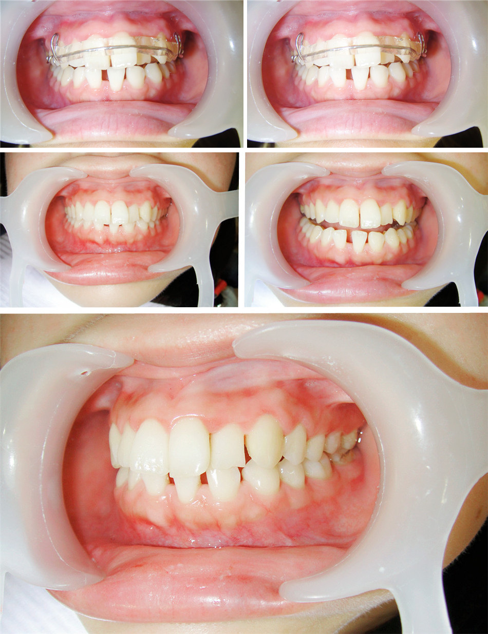 快速矯正,數位3D隱形矯正,3D數位隱形矯正,一日植牙