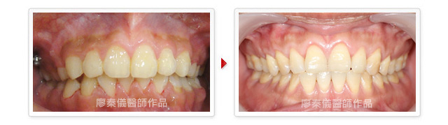 牙齦對稱手術,竹北牙齦對稱手術,雷射植牙,竹北雷射植牙,牙齦美容