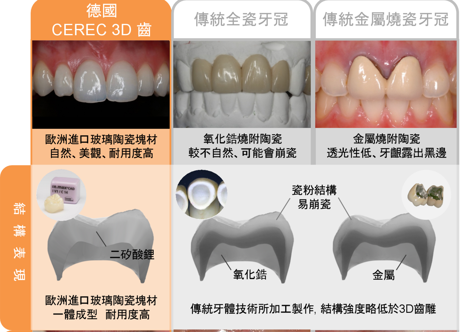 3d齒雕缺點，3d齒雕壽命，牙醫師填補缺損數位瓷塊形狀高度密合