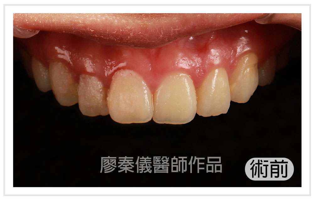 3D齒雕,3d齒雕缺點,美容牙科,竹北牙齒美白