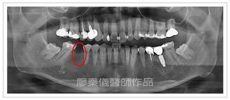 日本禁止植牙竹北可以植牙、allon4植牙費用、allon4失敗案例、一日植牙缺點、allon460萬、真美牙醫一日植牙
