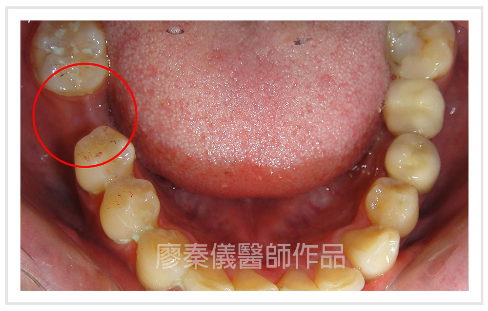 日本禁止植牙竹北可以植牙、allon4植牙費用、allon4失敗案例、一日植牙缺點、allon460萬、真美牙醫一日植牙