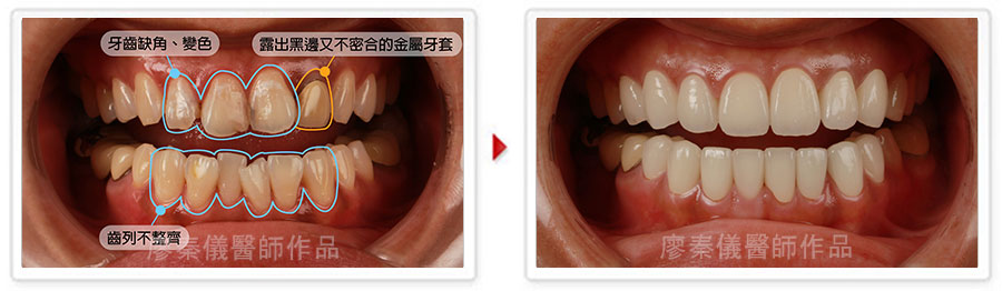 晶鑽全瓷,晶鑽薄型全瓷冠,美容牙科,3D齒雕,三合一植牙,牙齒美容,牙齒美白