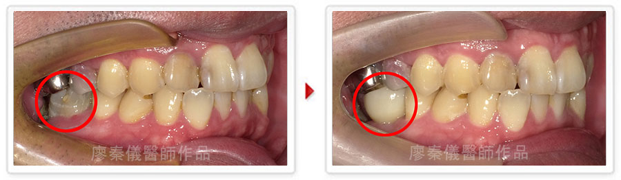 TCI舒眠牙醫治療,TCI舒眠植牙,舒眠植牙,三合一植牙,人工植牙