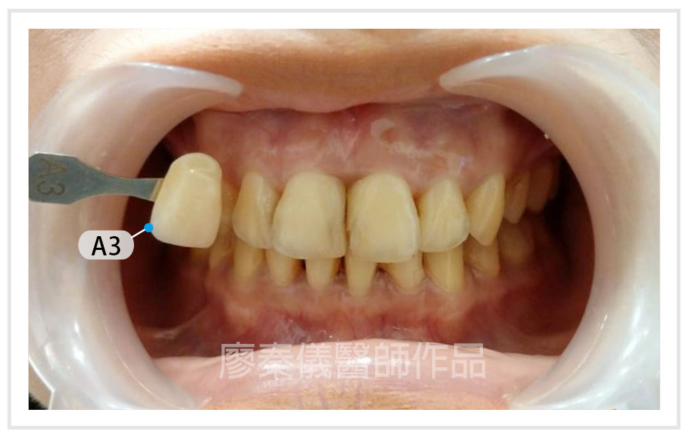 美容牙科,晶鑽全瓷,居家美白,牙齒美容,牙齒美白