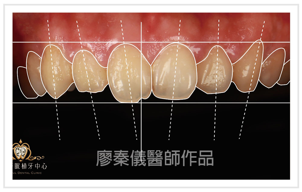 3D齒雕,3d齒雕缺點,美容牙科,竹北牙齒美白