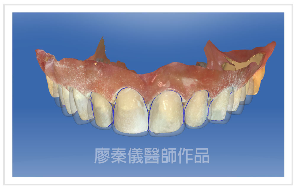 3D齒雕,3D齒雕CEREC,3d齒雕缺點,一日美齒CEREC,美容牙科,竹北牙齒美白