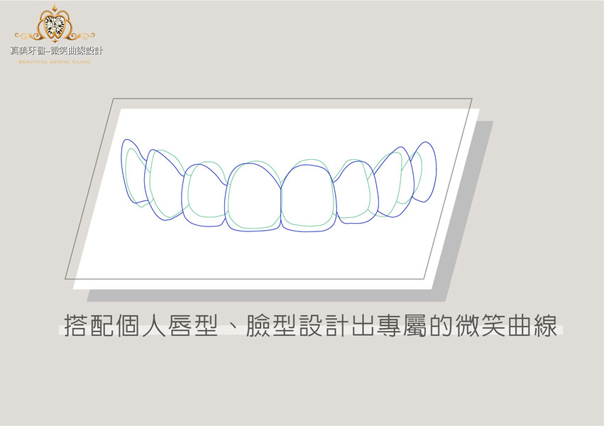 晶鑽全瓷,竹北晶鑽全瓷,晶鑽牙橋,竹北晶鑽牙橋,3D齒雕,美容牙科,舒眠植牙,植牙專科,新竹縣市牙醫診所