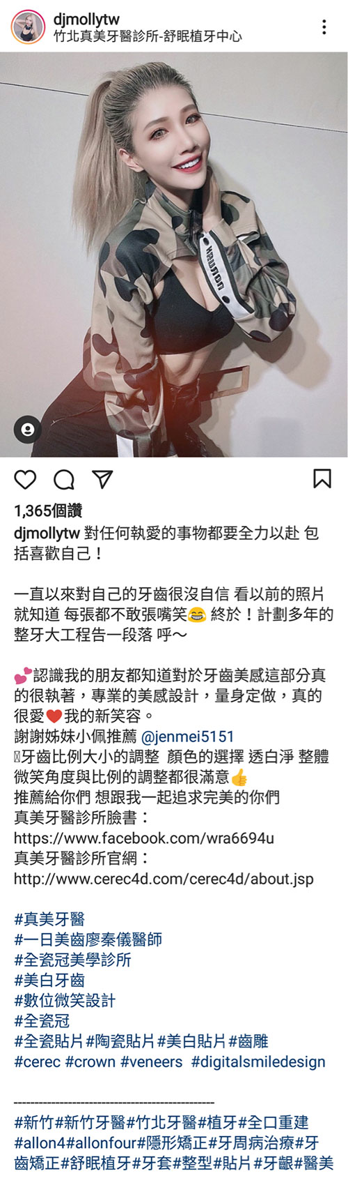 3D齒雕,3d齒雕缺點,美容牙科,竹北牙齒美白