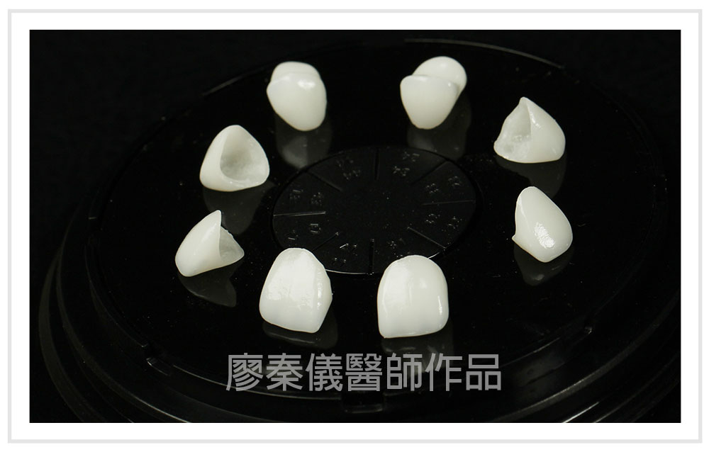 3D齒雕,竹北3D齒雕,美容牙科,3D齒雕門牙