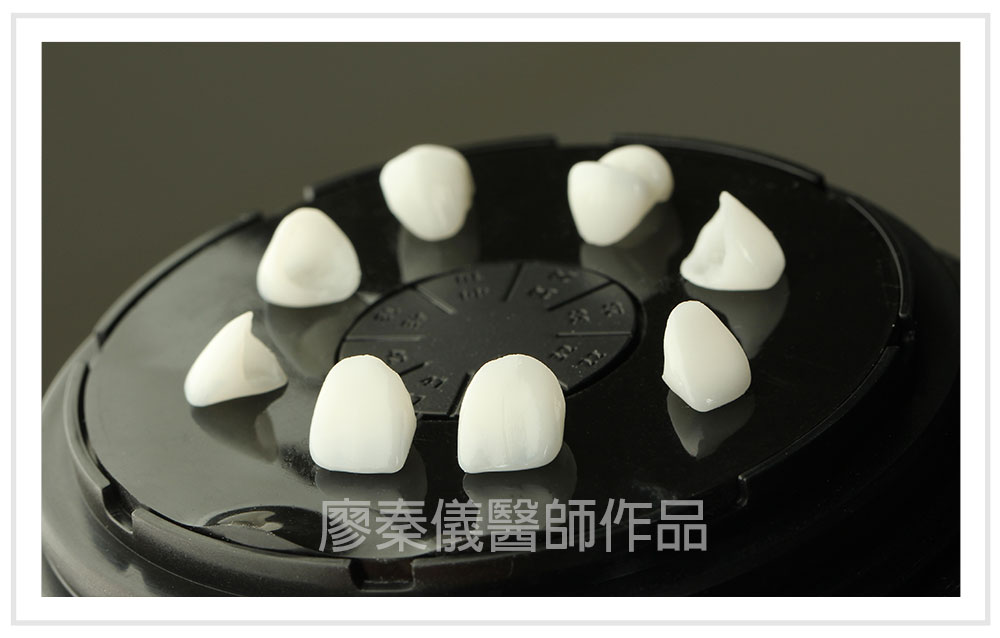 3D齒雕,竹北3D齒雕,美容牙科,3D齒雕門牙