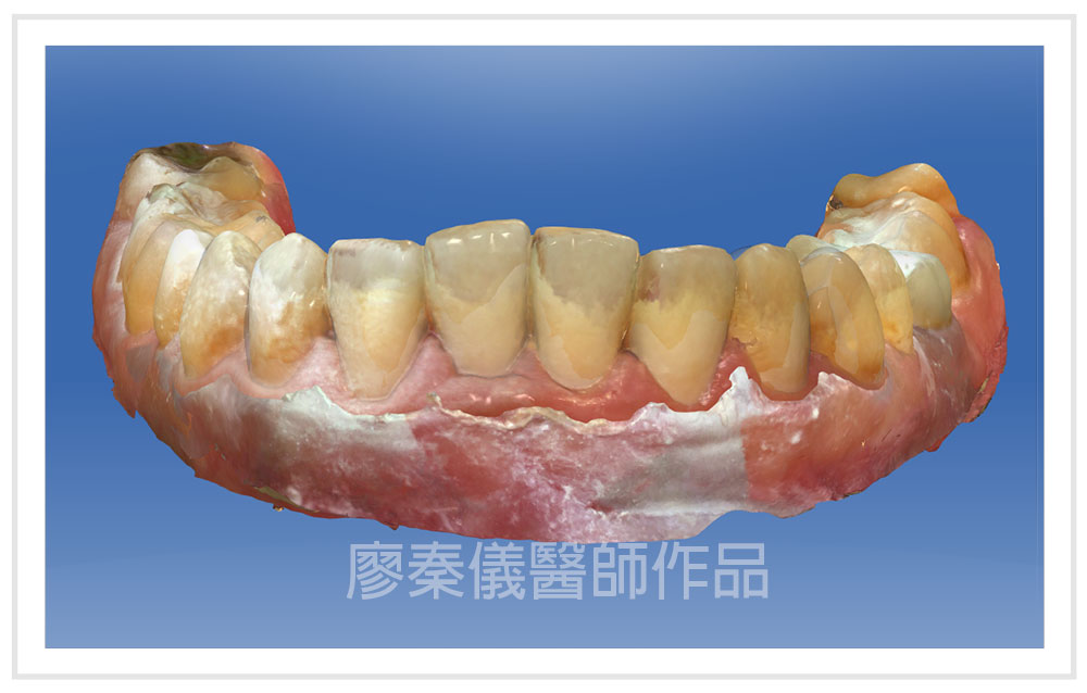 3D齒雕,竹北3D齒雕,美容牙科,3D齒雕門牙