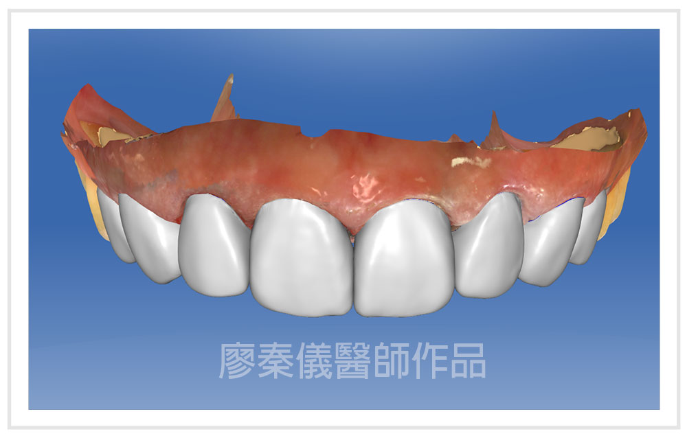 3D齒雕,竹北3D齒雕,美容牙科,3D齒雕門牙