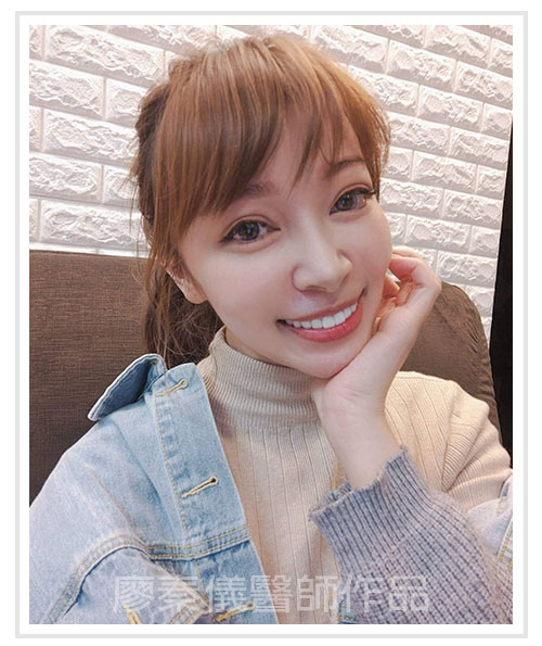 3D齒雕,竹北3D齒雕,美容牙科,3D齒雕門牙,新竹缺牙,竹北缺牙