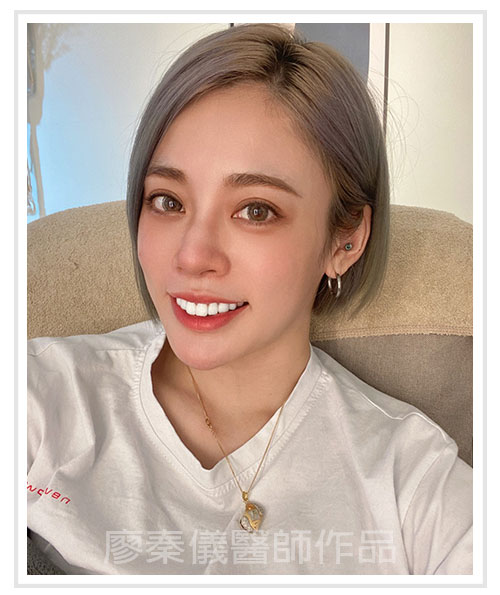 3D齒雕,牙齦對稱手術,美容牙科,3D齒雕門牙,晶鑽全瓷冠,竹北3D齒雕,竹北牙齦對稱手術,牙齦美容,一日美齒cerec,CEREC 3D齒雕
