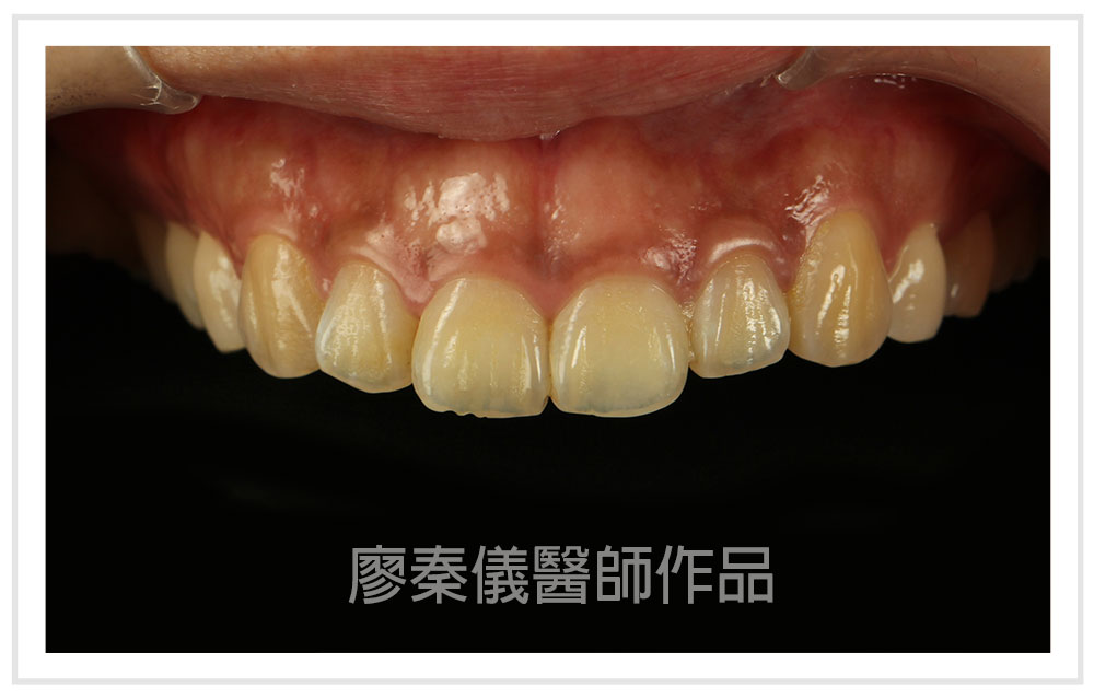 3D齒雕,牙齦對稱手術,美容牙科,3D齒雕門牙,晶鑽全瓷冠,竹北3D齒雕,竹北牙齦對稱手術,牙齦美容,一日美齒cerec,CEREC 3D齒雕