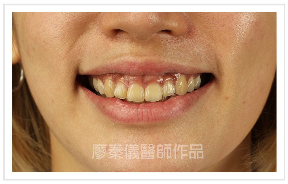 3D齒雕,牙齦對稱手術,美容牙科,3D齒雕門牙,晶鑽全瓷冠,竹北3D齒雕,竹北牙齦對稱手術,牙齦美容,一日美齒cerec,CEREC 3D齒雕