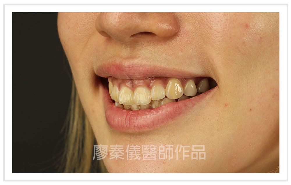 3D齒雕,牙齦對稱手術,美容牙科,3D齒雕門牙,晶鑽全瓷冠,竹北3D齒雕,竹北牙齦對稱手術,牙齦美容,一日美齒cerec,CEREC 3D齒雕