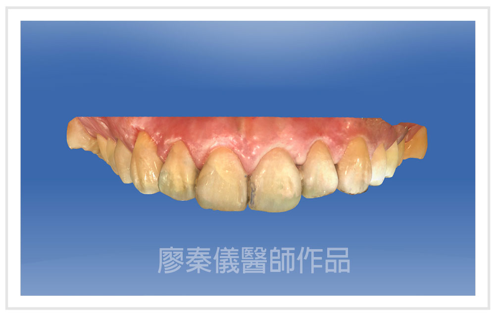3D齒雕,牙齦對稱手術,美容牙科,3D齒雕門牙,晶鑽全瓷冠,竹北3D齒雕,竹北牙齦對稱手術,牙齦美容,一日美齒cerec,CEREC 3D齒雕