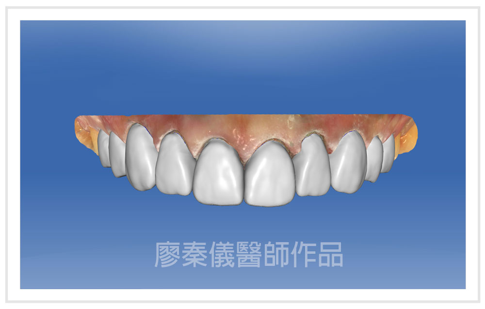 3D齒雕,牙齦對稱手術,美容牙科,3D齒雕門牙,晶鑽全瓷冠,竹北3D齒雕,竹北牙齦對稱手術,牙齦美容,一日美齒cerec,CEREC 3D齒雕
