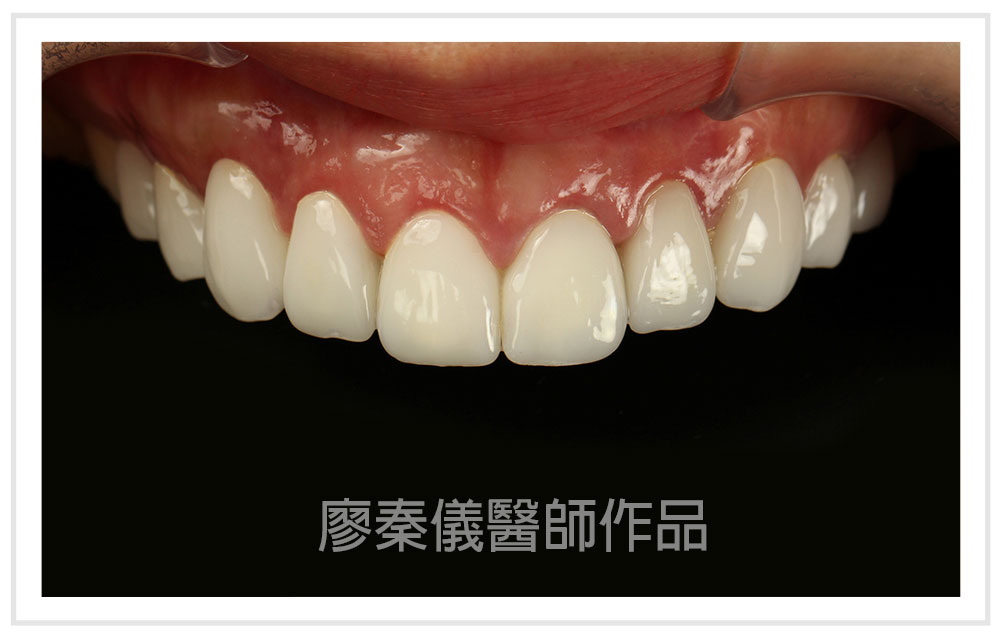 3D齒雕,牙齦對稱手術,美容牙科,3D齒雕門牙,晶鑽全瓷冠,竹北3D齒雕,竹北牙齦對稱手術,牙齦美容,一日美齒cerec,CEREC 3D齒雕