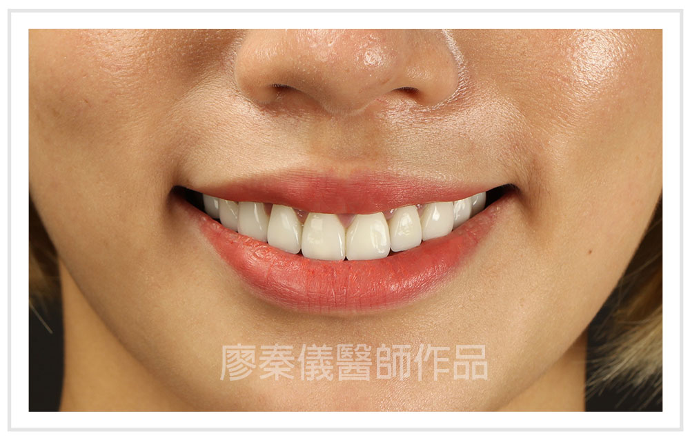 3D齒雕,牙齦對稱手術,美容牙科,3D齒雕門牙,晶鑽全瓷冠,竹北3D齒雕,竹北牙齦對稱手術,牙齦美容,一日美齒cerec,CEREC 3D齒雕