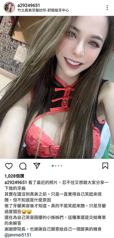上顎牙齦美容,美容牙科