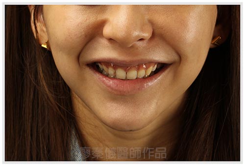 上顎牙齦美容,美容牙科