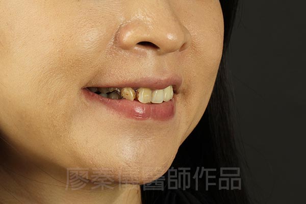 晶鑽全瓷