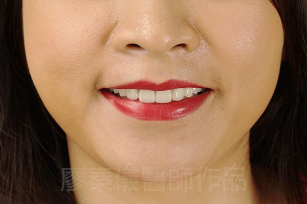 晶鑽全瓷