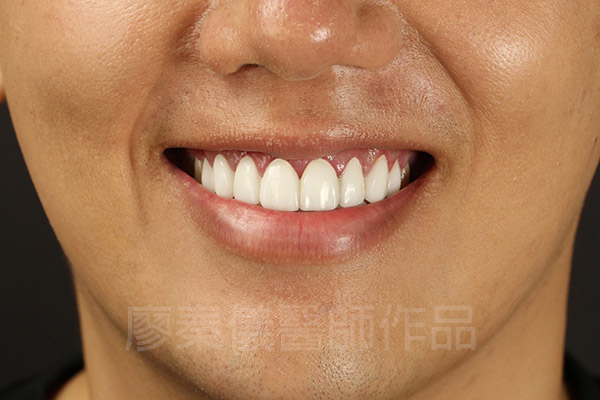 晶鑽全瓷
