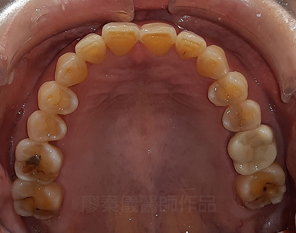 晶鑽全瓷,全口全瓷冠墊高咬合,重新恢復牙齒外觀及高度