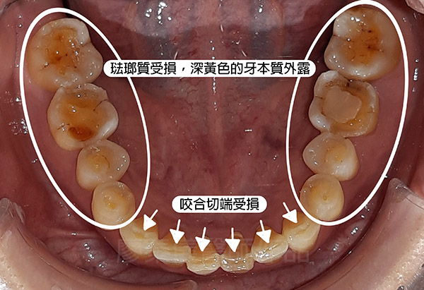 晶鑽全瓷,全口全瓷冠墊高咬合,重新恢復牙齒外觀及高度