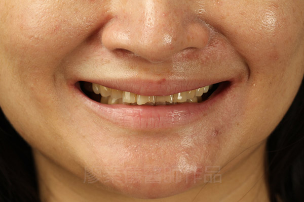 晶鑽全瓷,全口全瓷冠墊高咬合,重新恢復牙齒外觀及高度