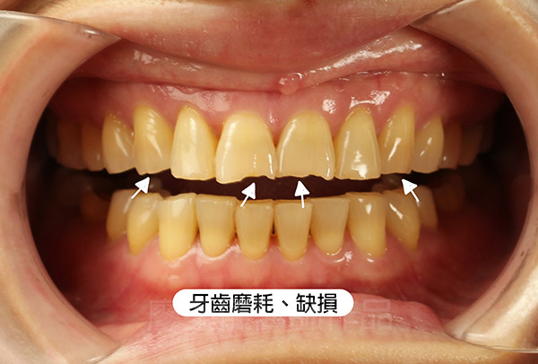 晶鑽全瓷,全口全瓷冠墊高咬合,重新恢復牙齒外觀及高度