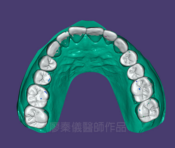 晶鑽全瓷,全口全瓷冠墊高咬合,重新恢復牙齒外觀及高度